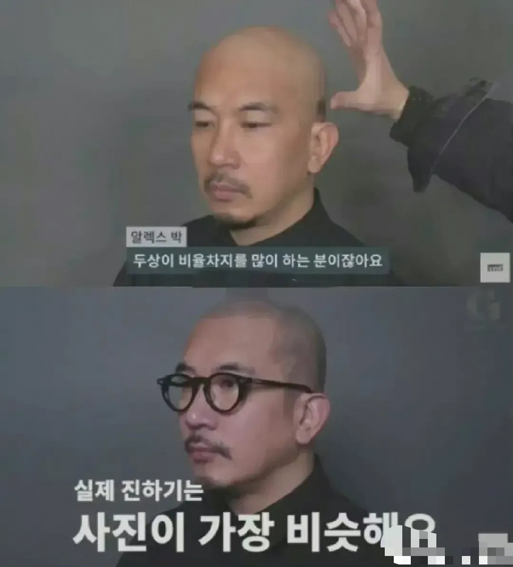 秃星人如何秒变发量王者？七种方法总有一个适合你！你学会了吗